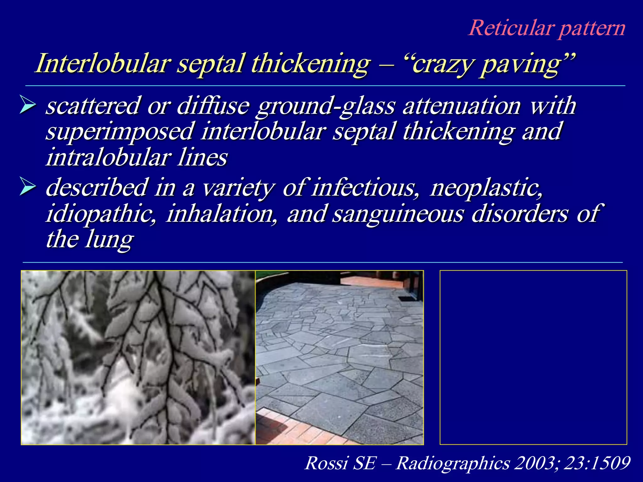 Reticular pattern
Interlobular septal thickening – “crazy paving”
 scattered or diffuse ground-glass attenuation with
superimposed interlobular septal thickening and
intralobular lines
 described in a variety of infectious, neoplastic,
idiopathic, inhalation, and sanguineous disorders of
the lung
Rossi SE – Radiographics 2003; 23:1509
 