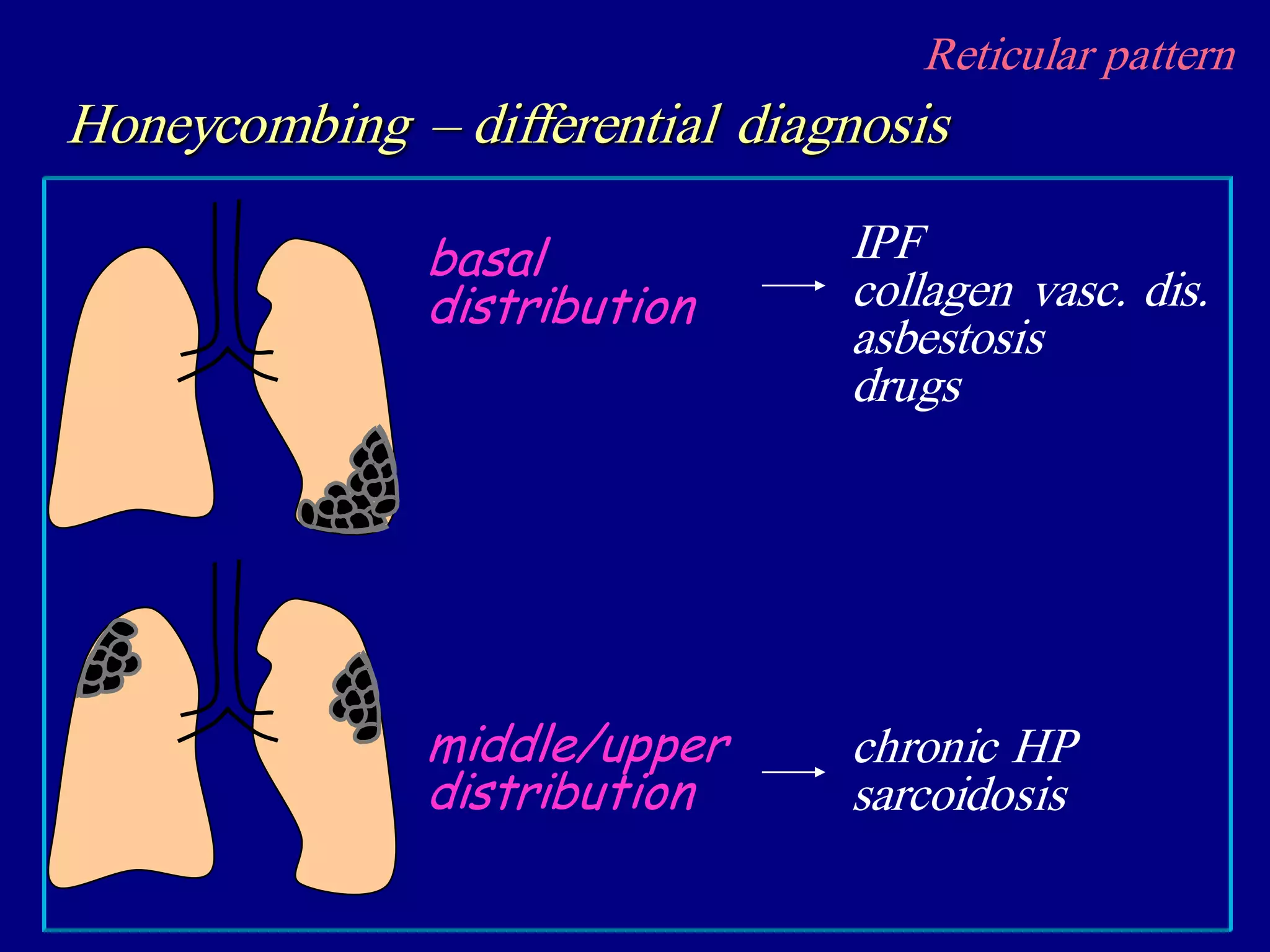Reticular pattern
Honeycombing – differential diagnosis
basal
distribution
middle/upper
distribution
chronic HP
sarcoidosis
IPF
collagen vasc. dis.
asbestosis
drugs
 