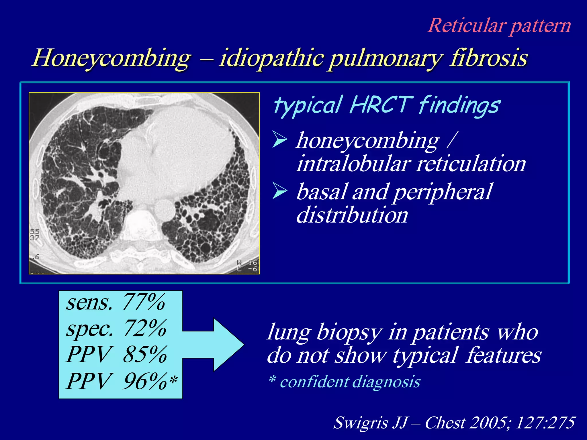  honeycombing /
intralobular reticulation
 basal and peripheral
distribution
typical HRCT findings
sens. 77%
spec. 72%
PPV 85%
PPV 96%*
Swigris JJ – Chest 2005; 127:275
lung biopsy in patients who
do not show typical features
Reticular pattern
Honeycombing – idiopathic pulmonary fibrosis
* confident diagnosis
 