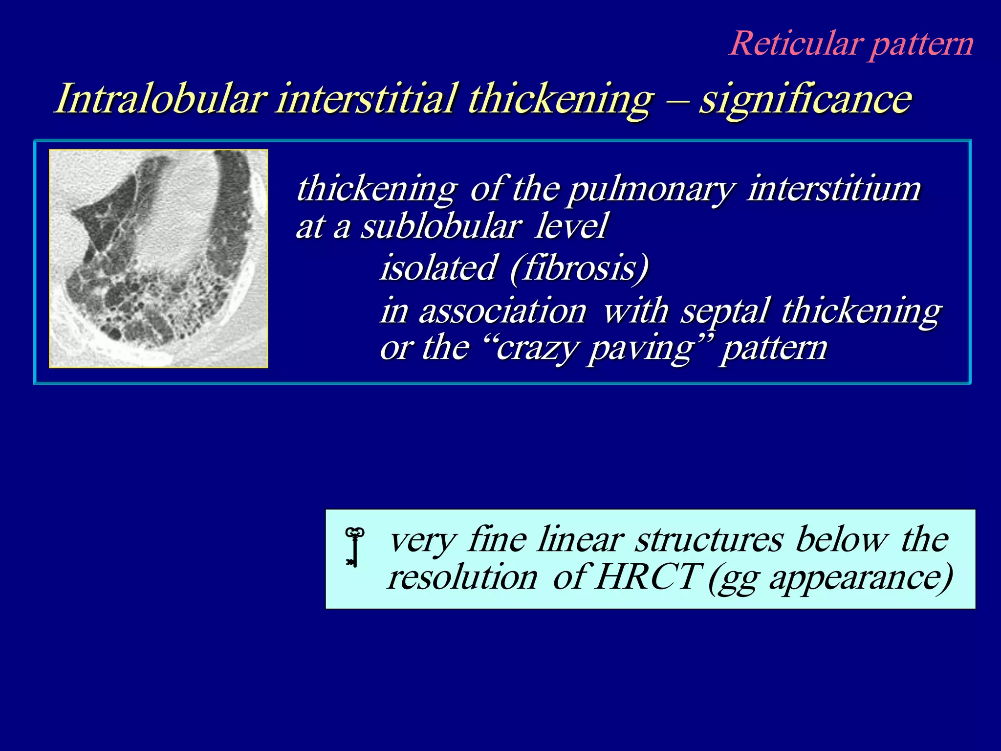 Reticular pattern
Intralobular interstitial thickening – significance
thickening of the pulmonary interstitium
at a sublobular level
isolated (fibrosis)
in association with septal thickening
or the “crazy paving” pattern
very fine linear structures below the
resolution of HRCT (gg appearance)

 