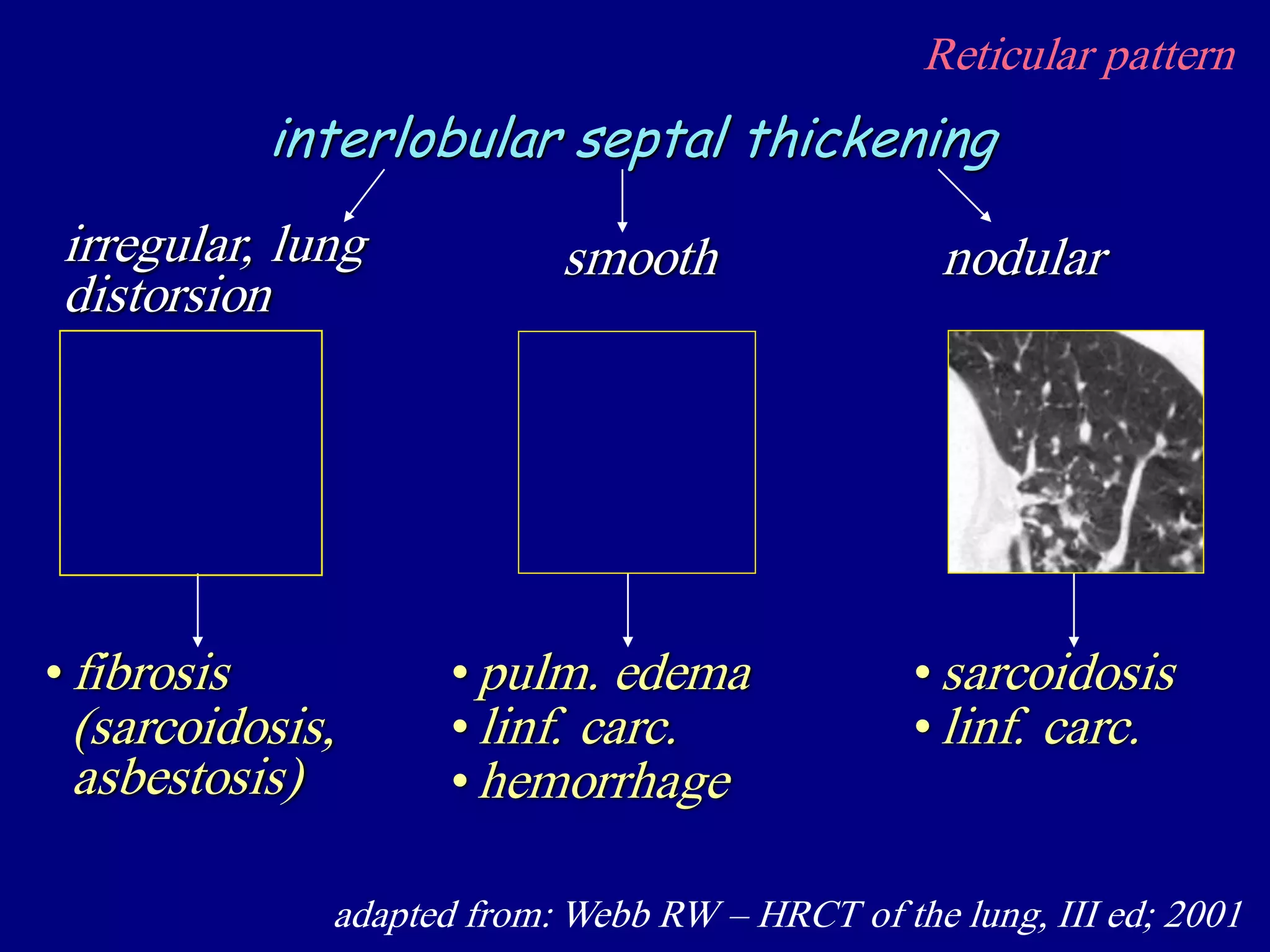 Reticular pattern
adapted from: Webb RW – HRCT of the lung, III ed; 2001
interlobular septal thickening
irregular, lung
distorsion
nodularsmooth
•fibrosis
(sarcoidosis,
asbestosis)
•pulm. edema
•linf. carc.
•hemorrhage
• sarcoidosis
• linf. carc.
 