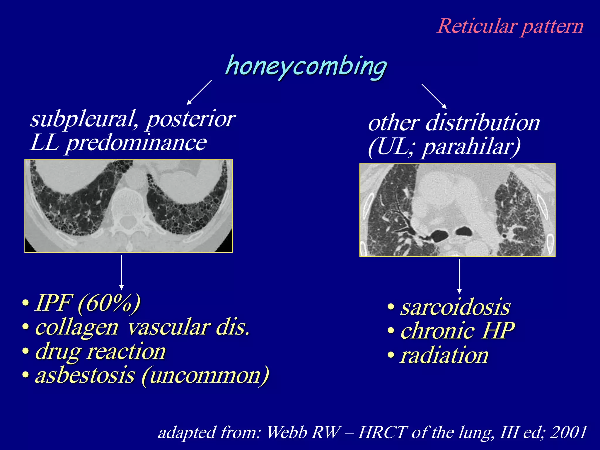 Reticular pattern
adapted from: Webb RW – HRCT of the lung, III ed; 2001
honeycombing
•IPF (60%)
•collagen vascular dis.
• drug reaction
•asbestosis (uncommon)
subpleural, posterior
LL predominance
• sarcoidosis
• chronic HP
• radiation
other distribution
(UL; parahilar)
 