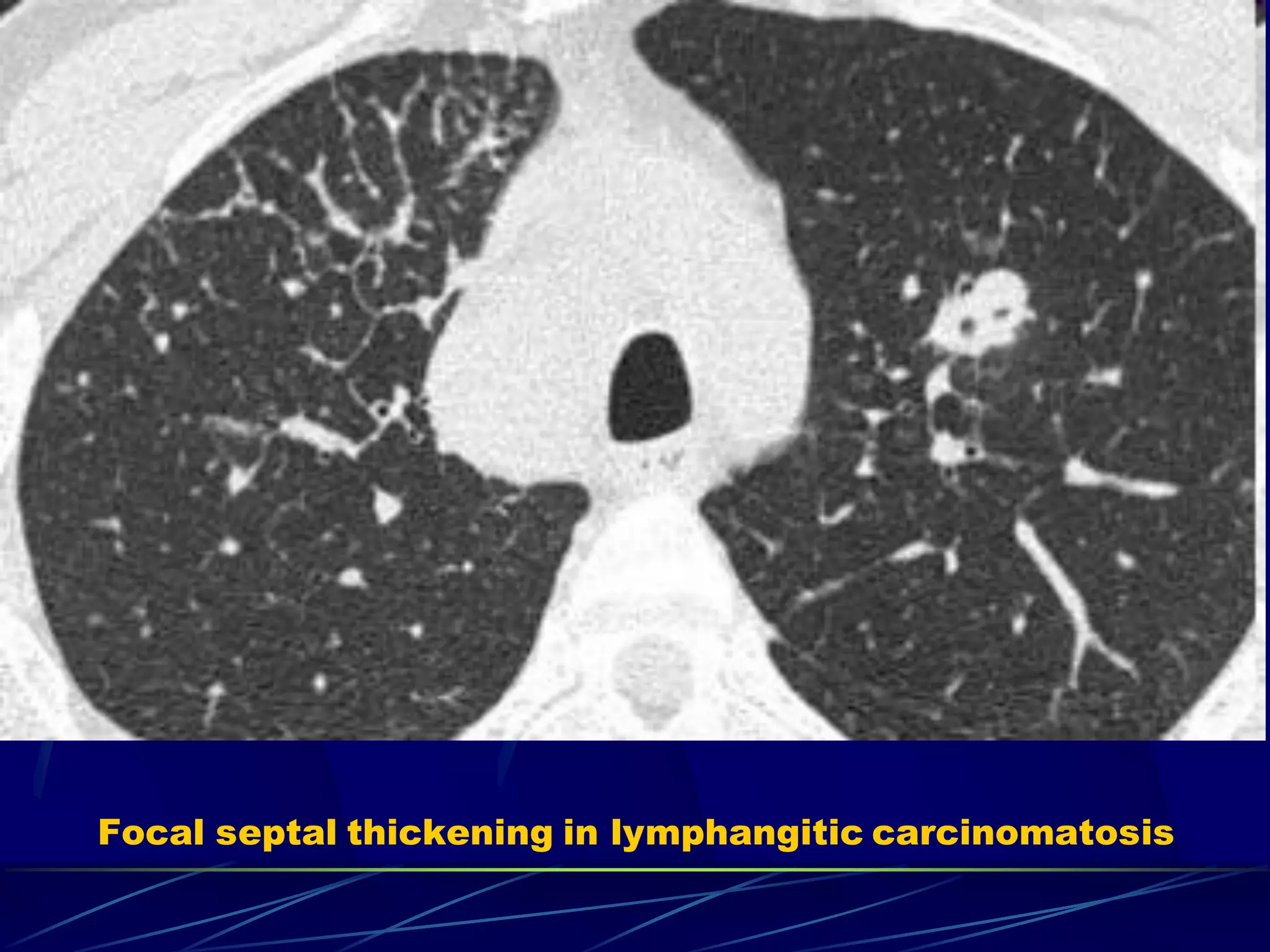 Focal septal thickening in lymphangitic carcinomatosis
 