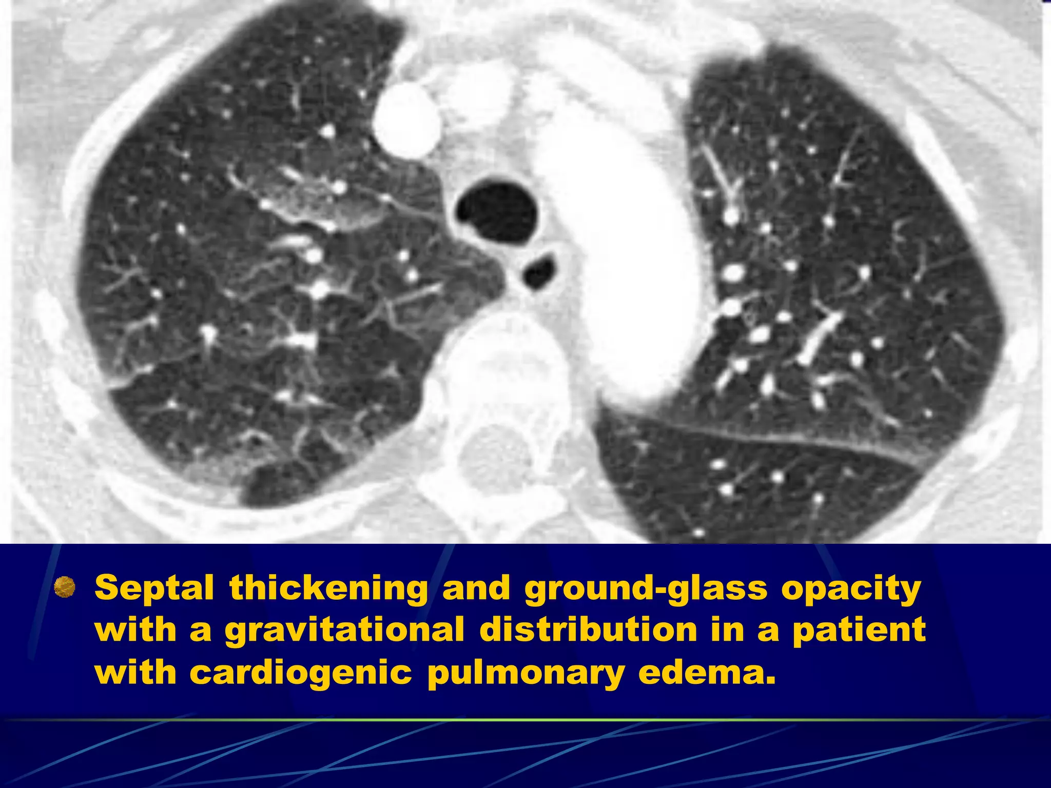 Septal thickening and ground-glass opacity
with a gravitational distribution in a patient
with cardiogenic pulmonary edema.
 