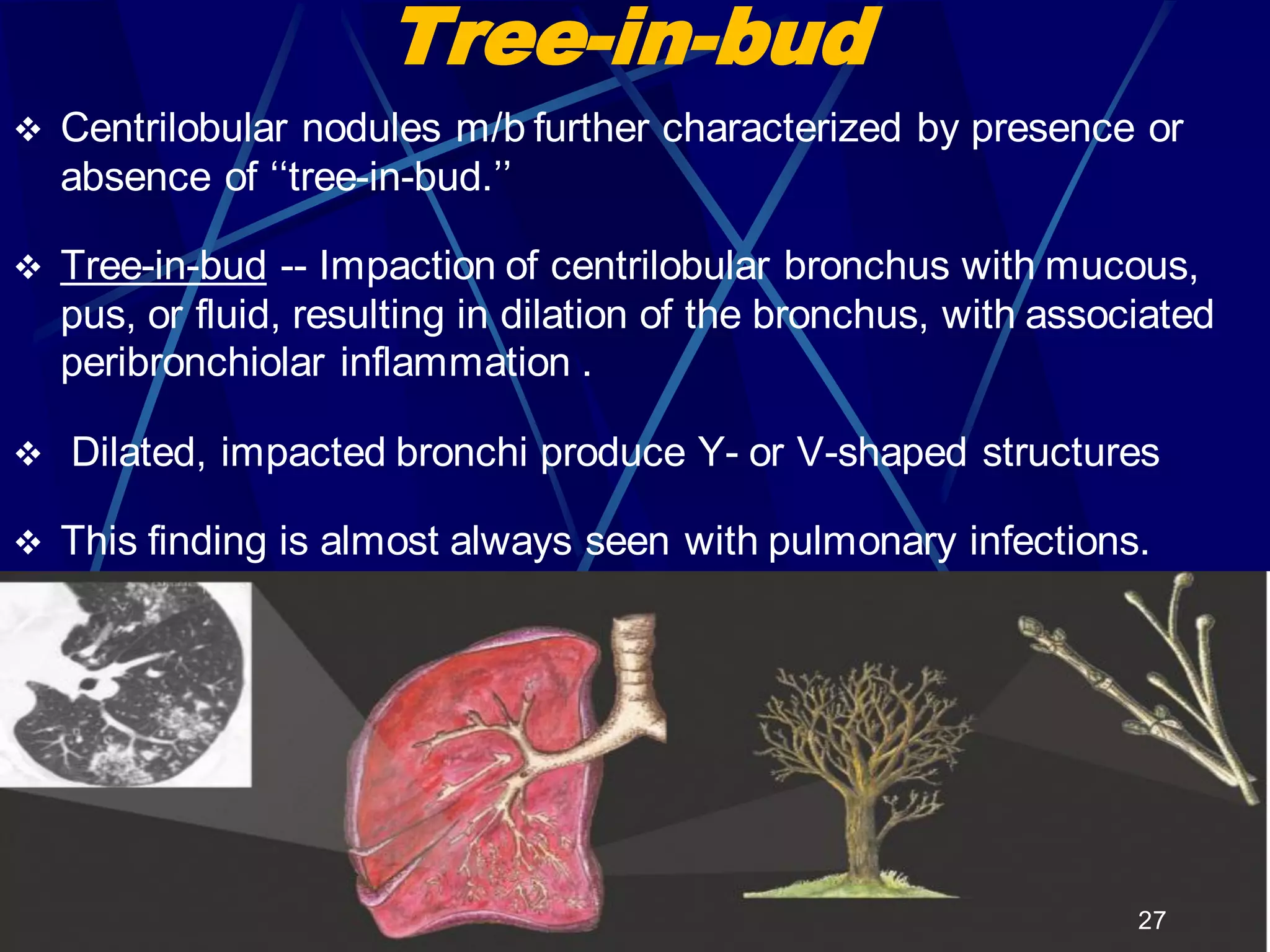 Tree-in-bud
 Centrilobular nodules m/b further characterized by presence or
absence of ‘‘tree-in-bud.’’
 Tree-in-bud -- Impaction of centrilobular bronchus with mucous,
pus, or fluid, resulting in dilation of the bronchus, with associated
peribronchiolar inflammation .
 Dilated, impacted bronchi produce Y- or V-shaped structures
 This finding is almost always seen with pulmonary infections.
27
 