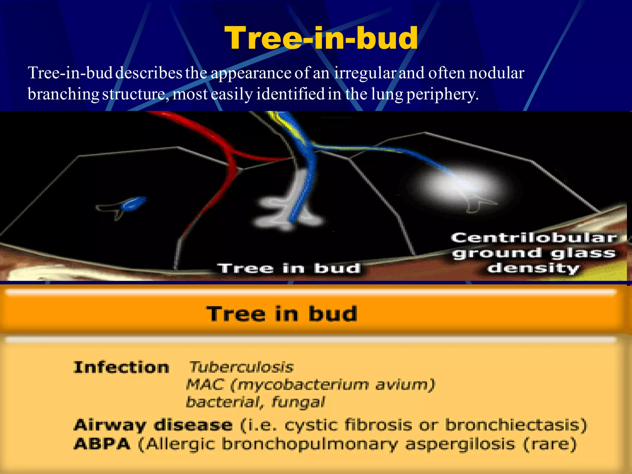 Tree-in-bud
Tree-in-buddescribesthe appearance of an irregularand often nodular
branchingstructure, most easily identifiedin the lung periphery.
 