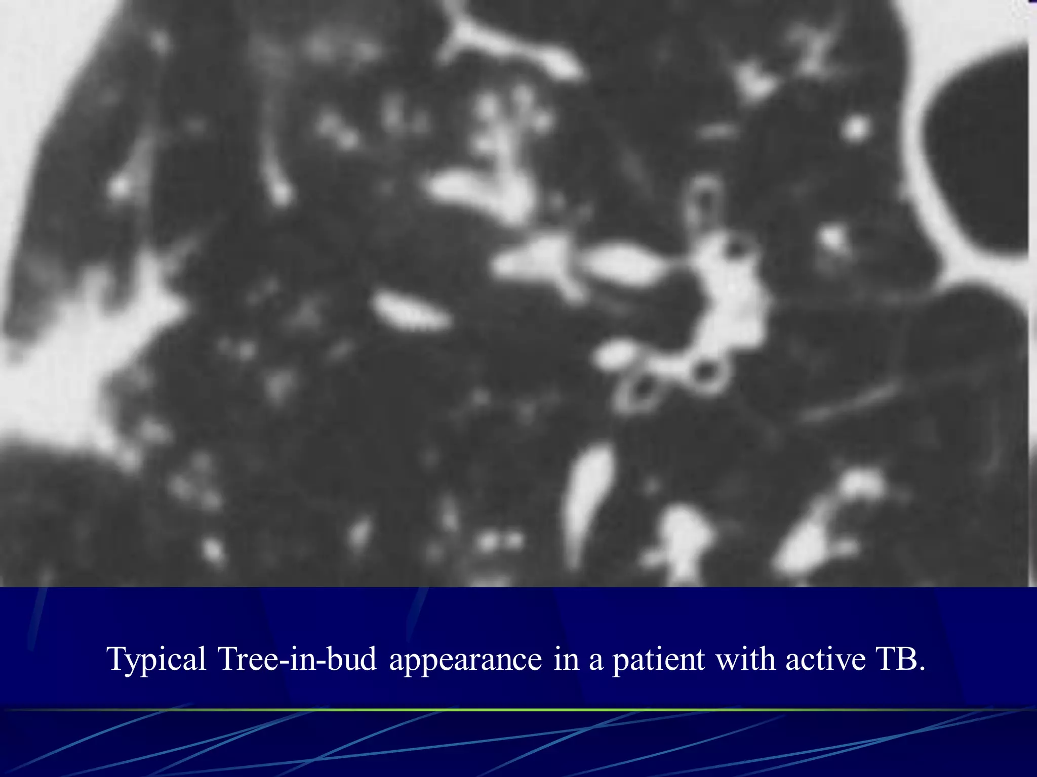 Typical Tree-in-bud appearance in a patient with active TB.
 