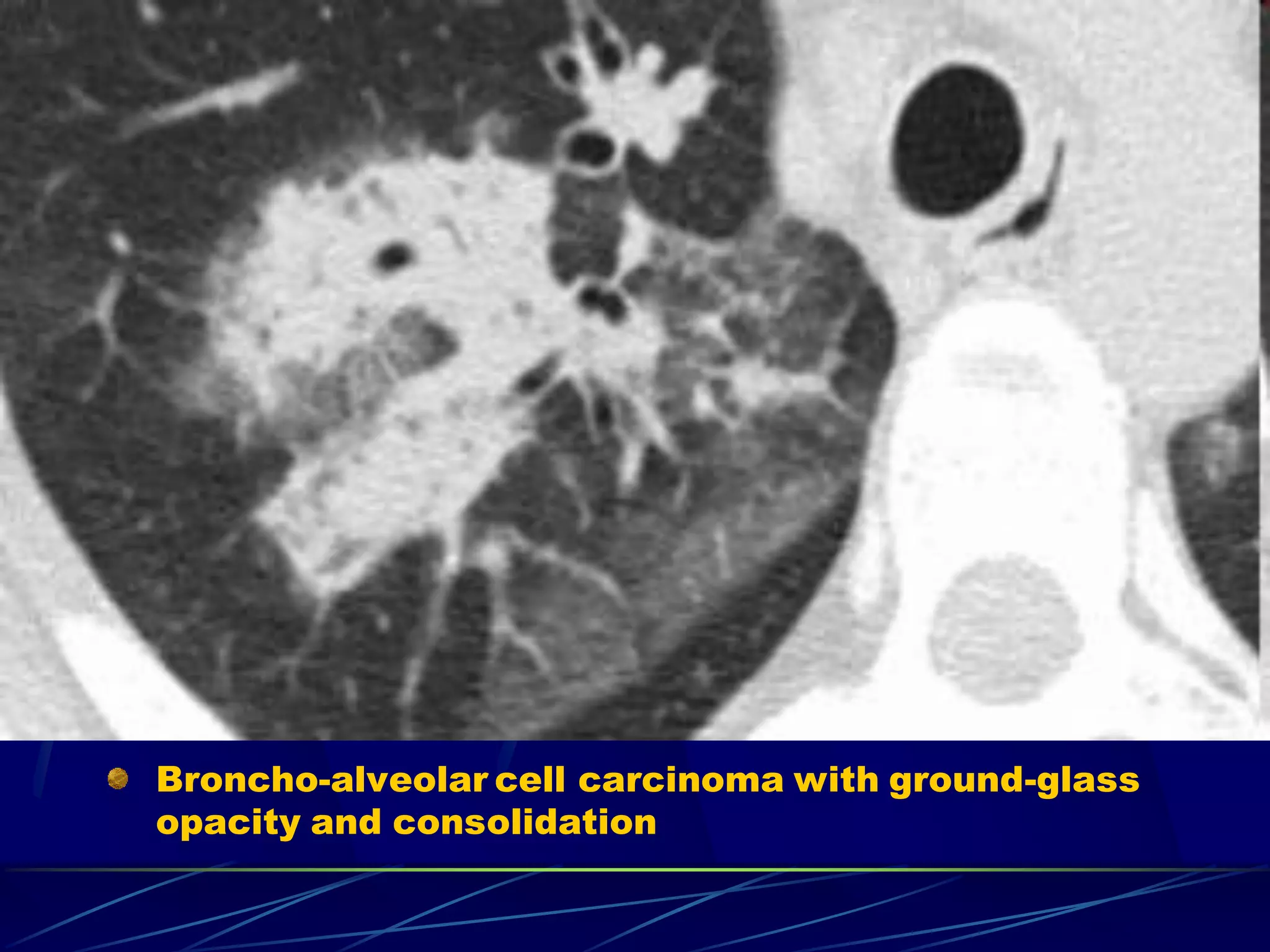 Broncho-alveolar cell carcinoma with ground-glass
opacity and consolidation
 