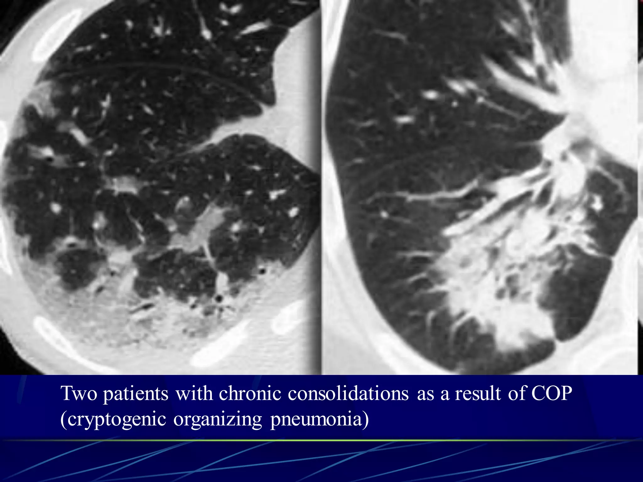 Two patients with chronic consolidations as a result of COP
(cryptogenic organizing pneumonia)
 