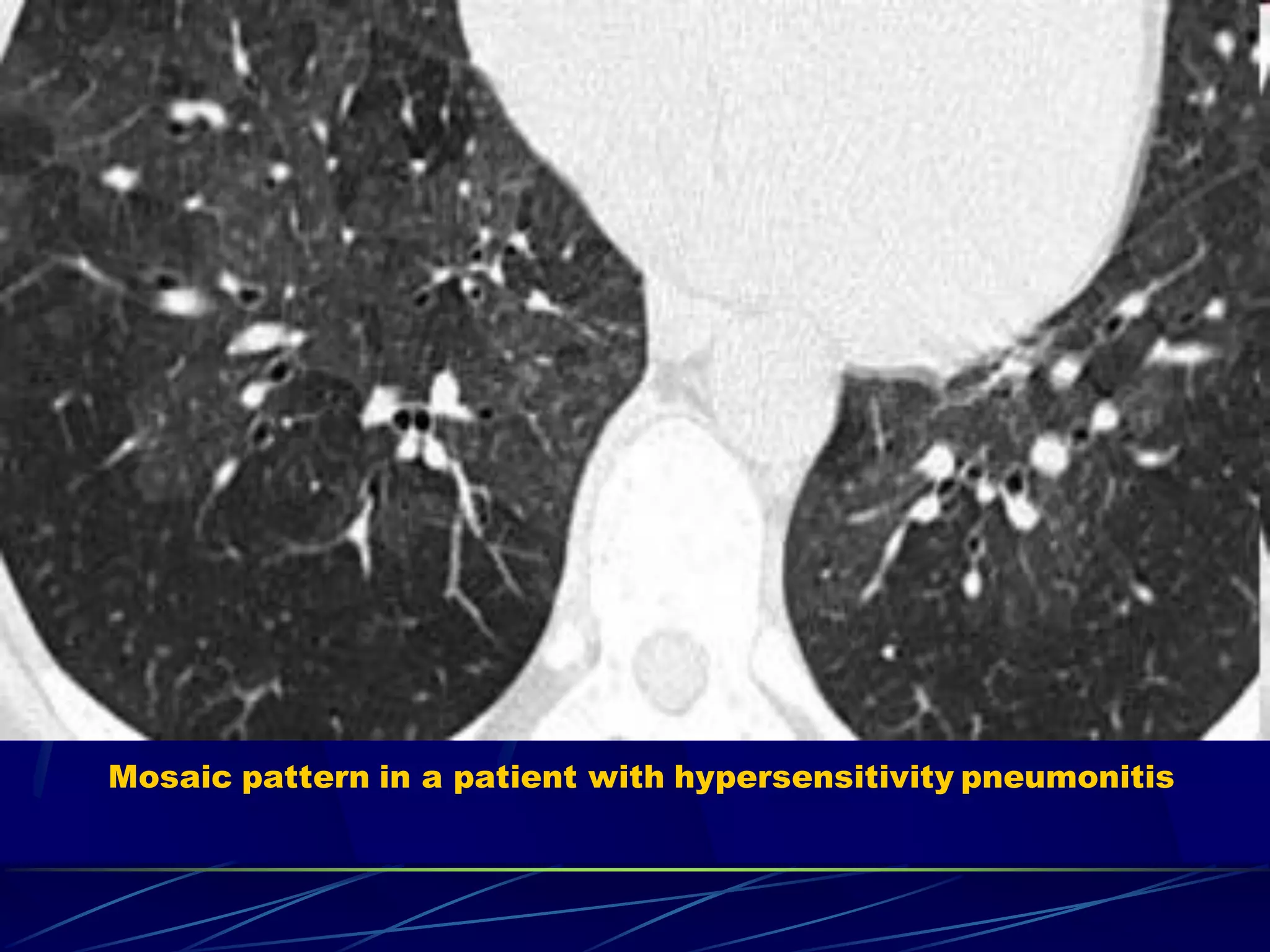 Mosaic pattern in a patient with hypersensitivity pneumonitis
 