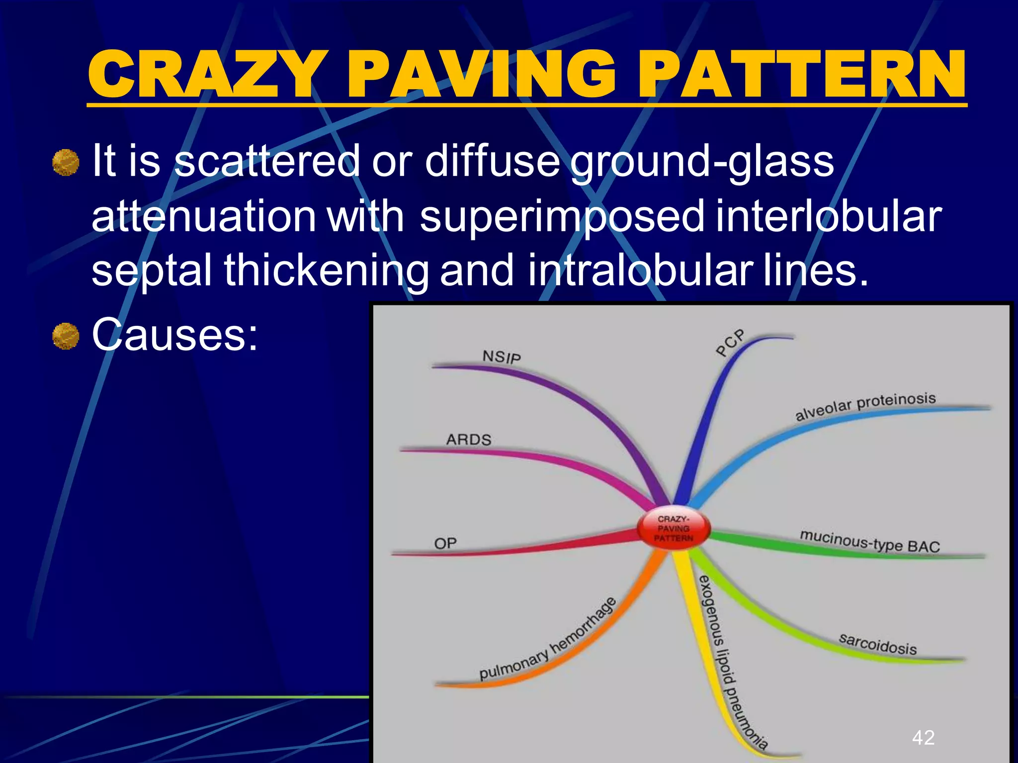 CRAZY PAVING PATTERN
It is scattered or diffuse ground-glass
attenuation with superimposed interlobular
septal thickening and intralobular lines.
Causes:
42
 