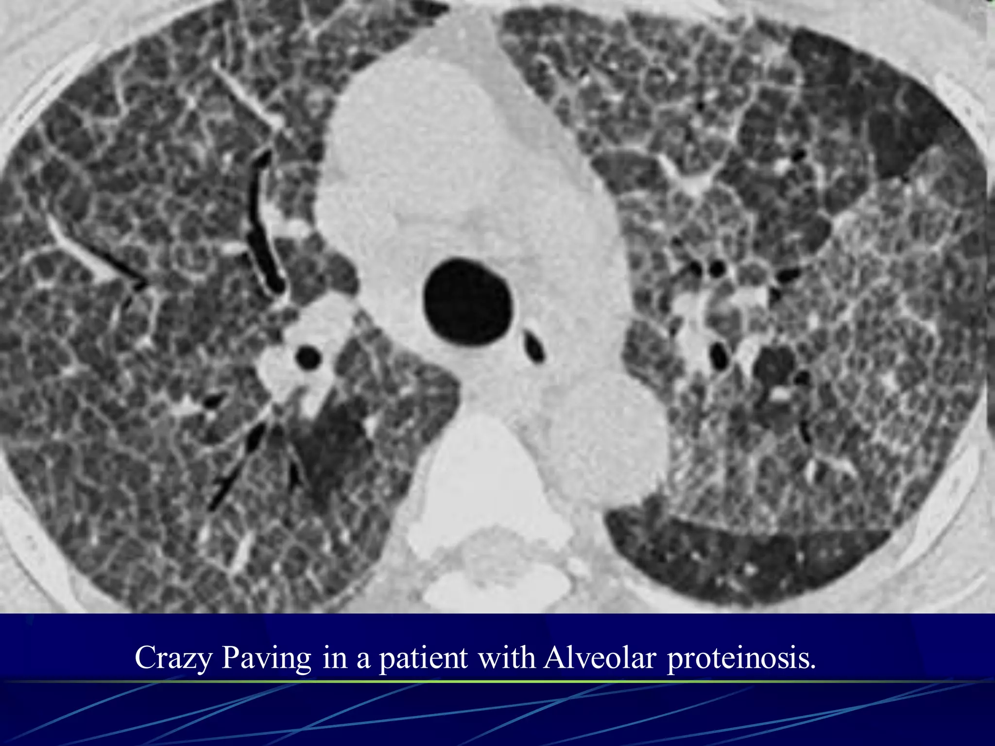 Crazy Paving in a patient with Alveolar proteinosis.
 