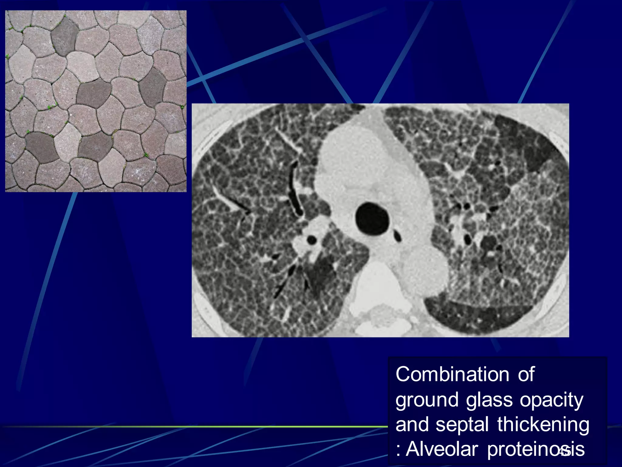 Combination of
ground glass opacity
and septal thickening
: Alveolar proteinosis45
 