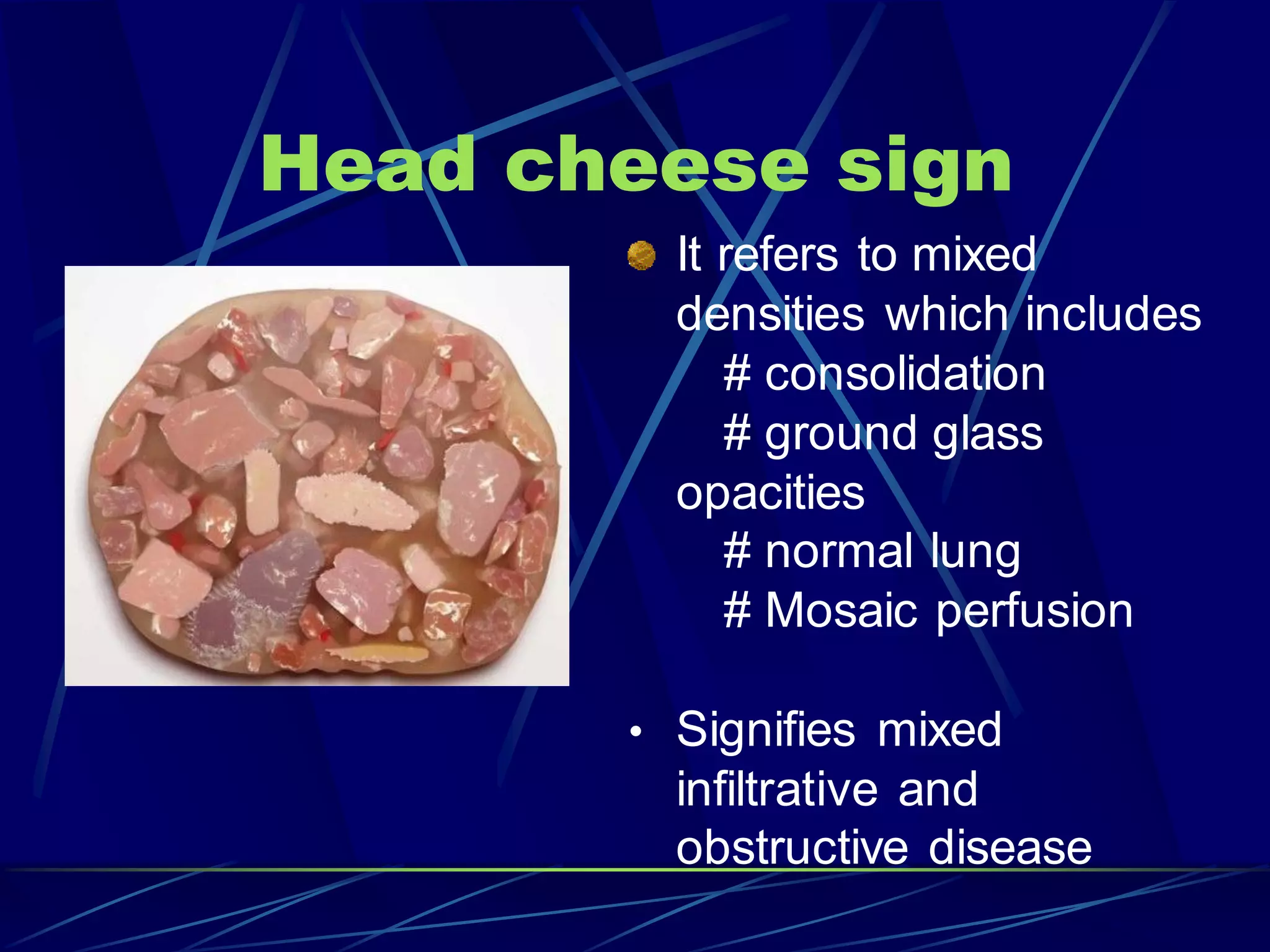 Head cheese sign
It refers to mixed
densities which includes
# consolidation
# ground glass
opacities
# normal lung
# Mosaic perfusion
• Signifies mixed
infiltrative and
obstructive disease
 