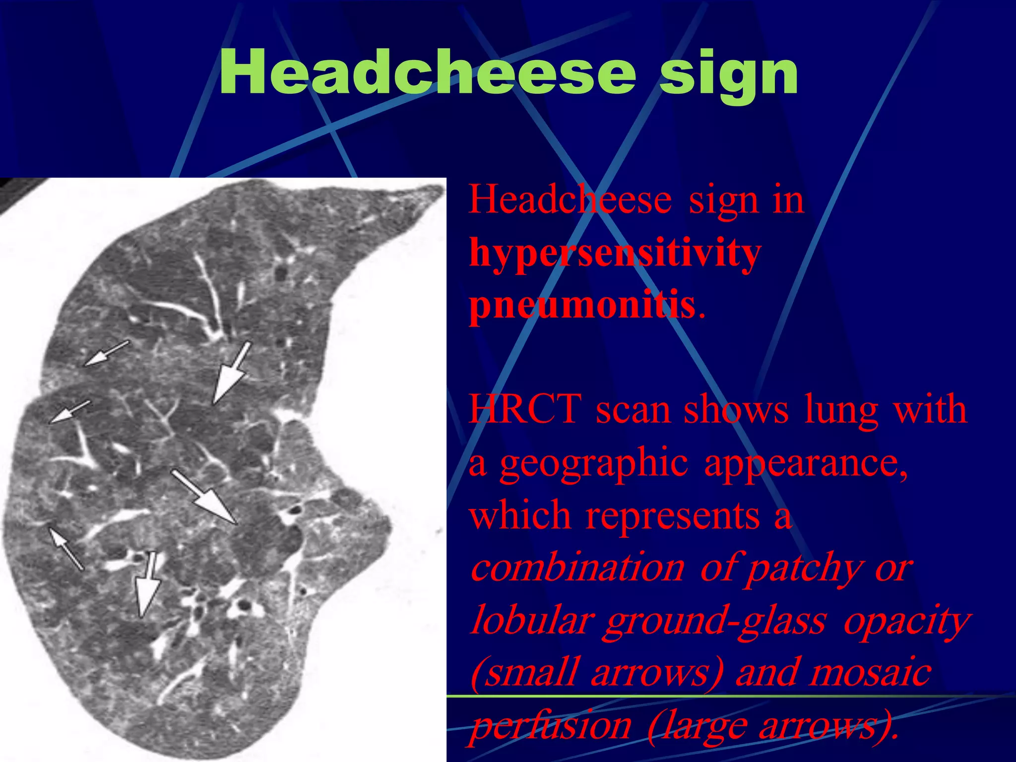 Headcheese sign
Headcheese sign in
hypersensitivity
pneumonitis.
HRCT scan shows lung with
a geographic appearance,
which represents a
combination of patchy or
lobular ground-glass opacity
(small arrows) and mosaic
perfusion (large arrows).
 