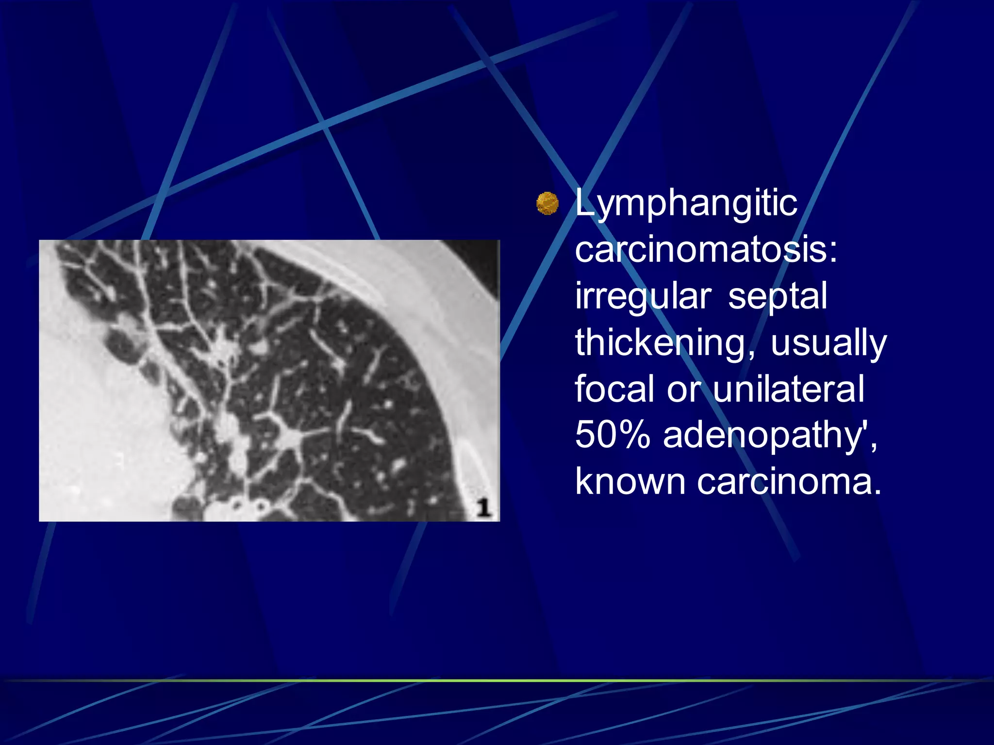 Lymphangitic
carcinomatosis:
irregular septal
thickening, usually
focal or unilateral
50% adenopathy',
known carcinoma.
 
