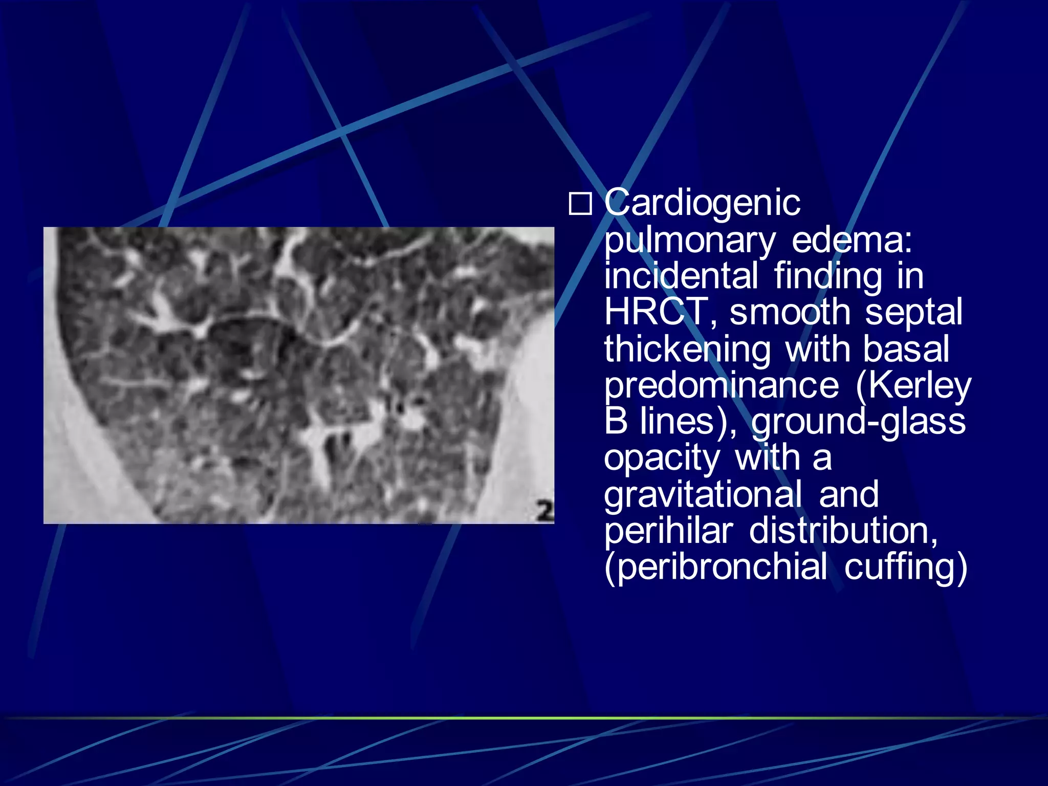  Cardiogenic
pulmonary edema:
incidental finding in
HRCT, smooth septal
thickening with basal
predominance (Kerley
B lines), ground-glass
opacity with a
gravitational and
perihilar distribution,
(peribronchial cuffing)
 