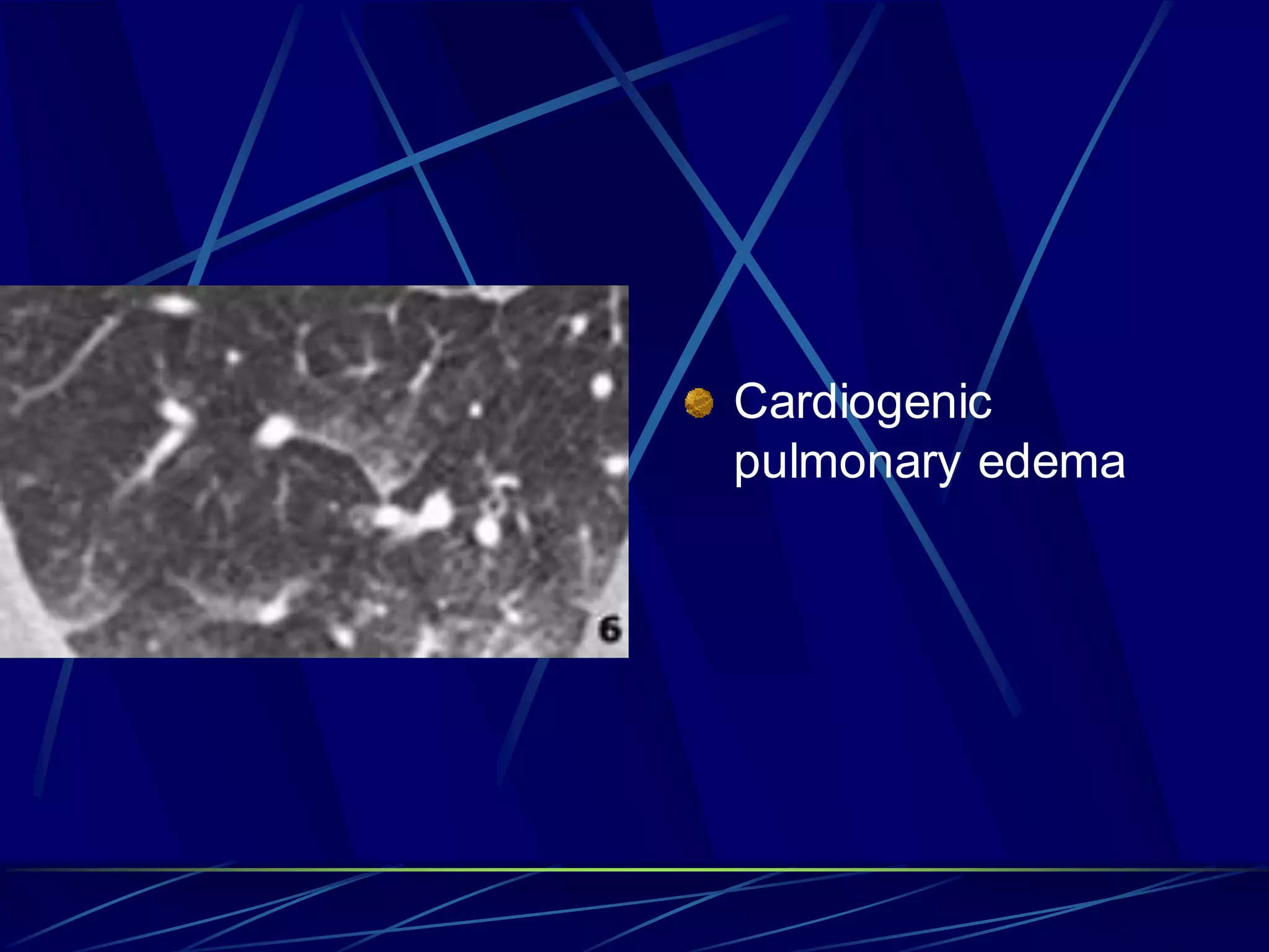 Cardiogenic
pulmonary edema
 