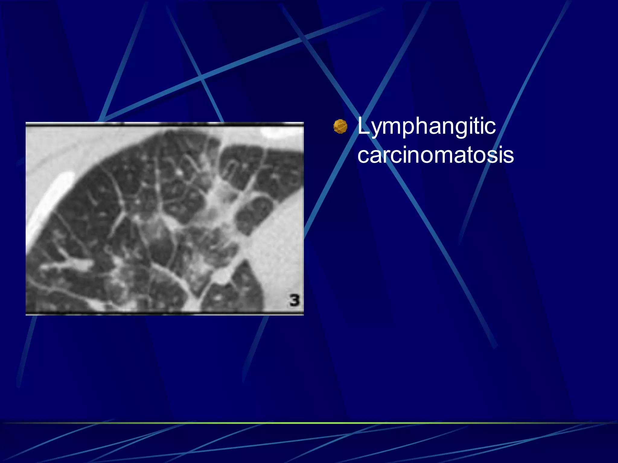 Lymphangitic
carcinomatosis
 