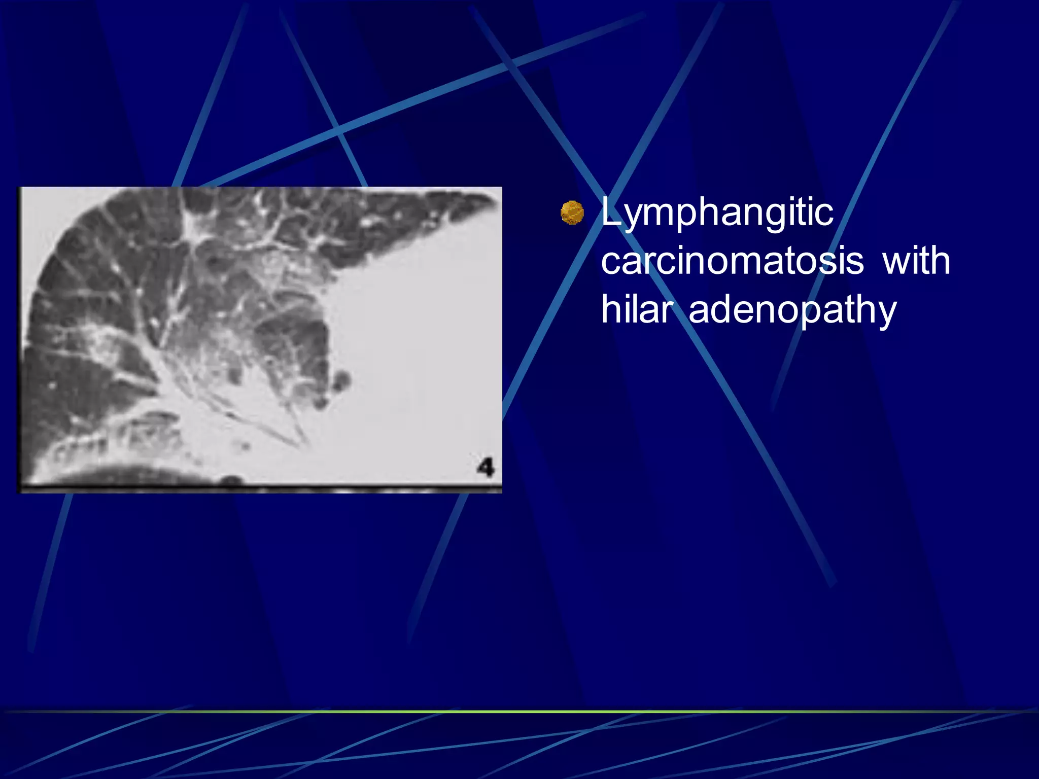 Lymphangitic
carcinomatosis with
hilar adenopathy
 