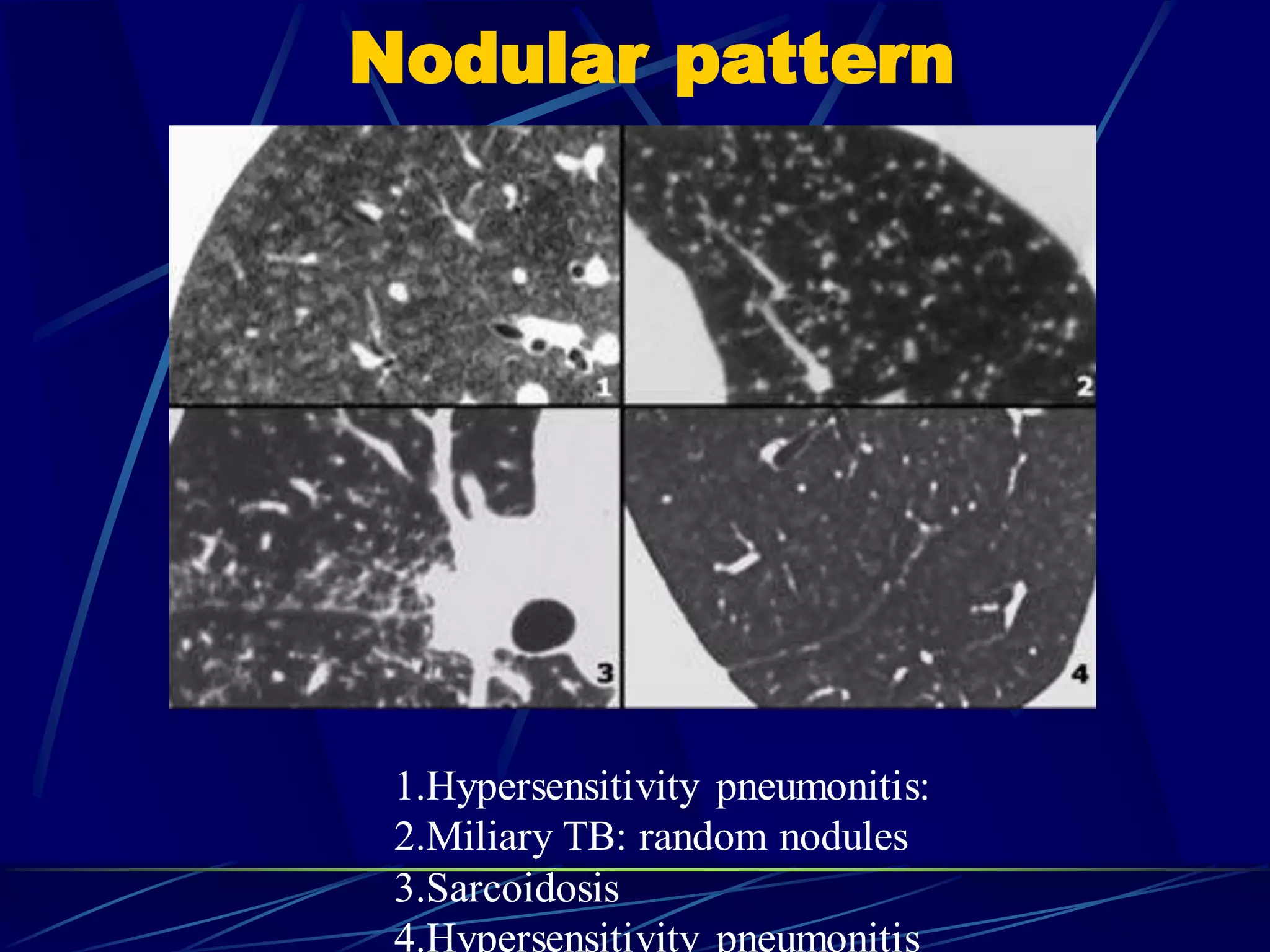 Nodular pattern
1.Hypersensitivity pneumonitis:
2.Miliary TB: random nodules
3.Sarcoidosis
4.Hypersensitivity pneumonitis
 