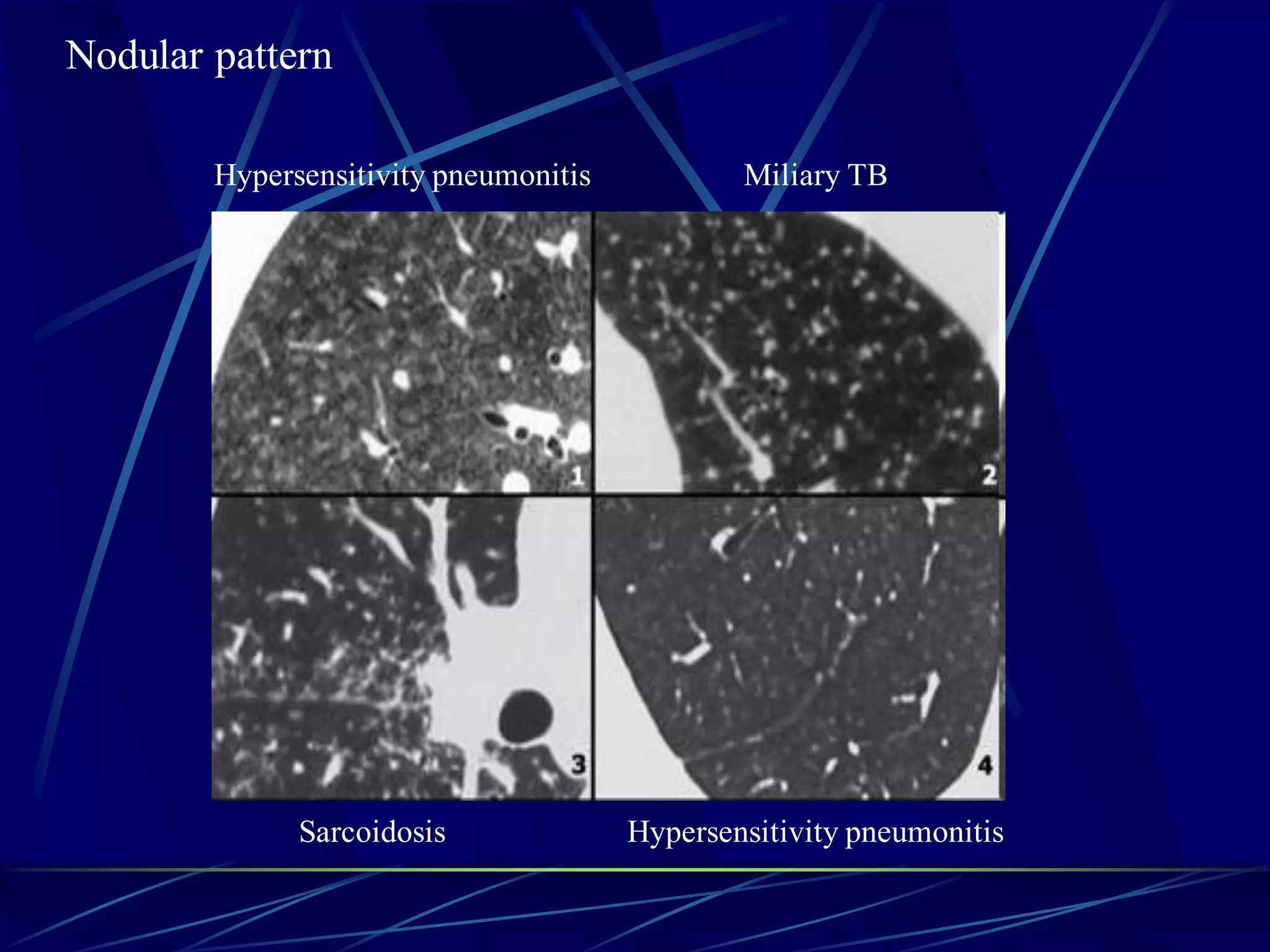 Nodular pattern
Hypersensitivity pneumonitis Miliary TB
Sarcoidosis Hypersensitivity pneumonitis
 