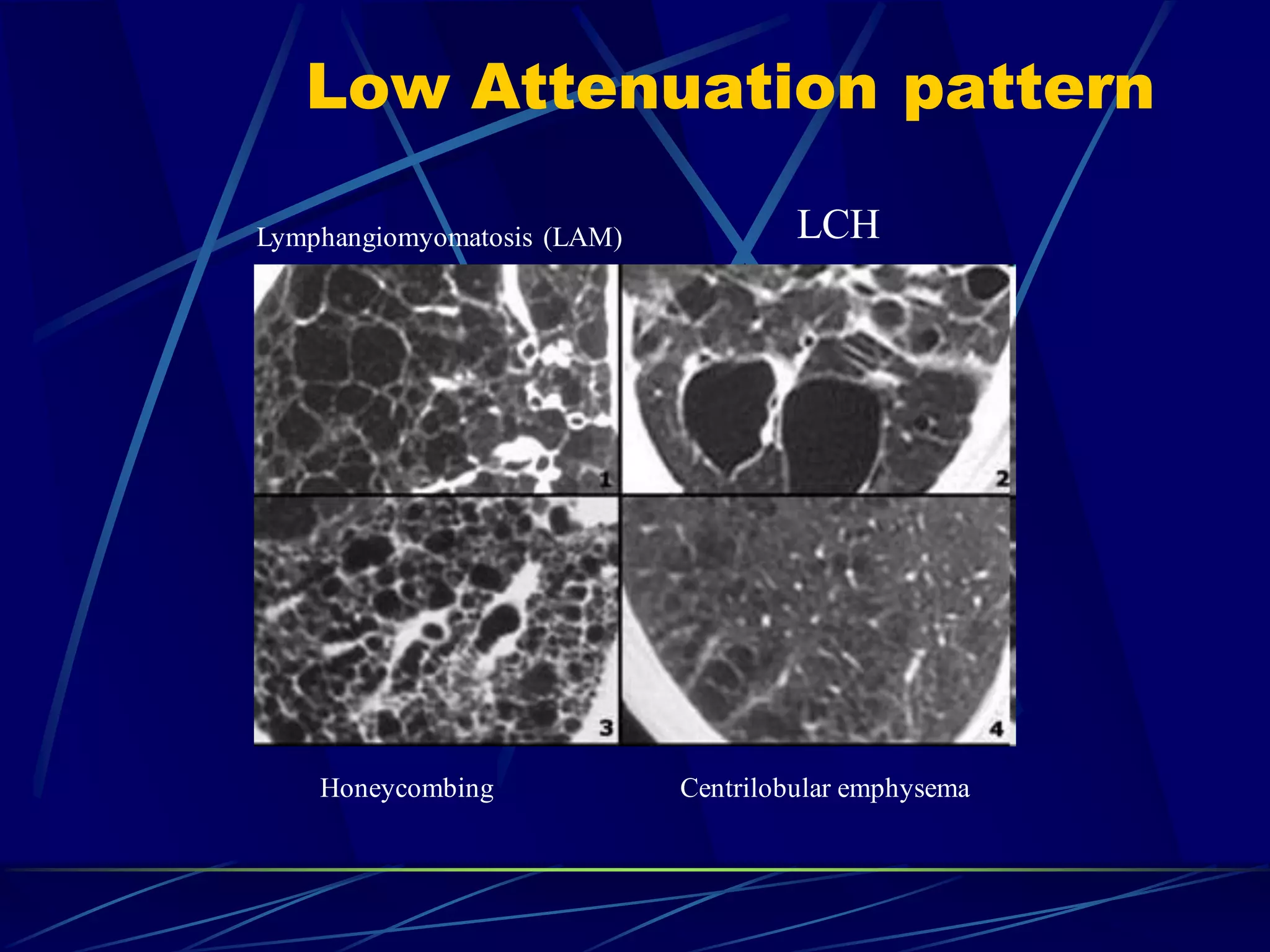 Low Attenuation pattern
Lymphangiomyomatosis (LAM) LCH
Honeycombing Centrilobular emphysema
 
