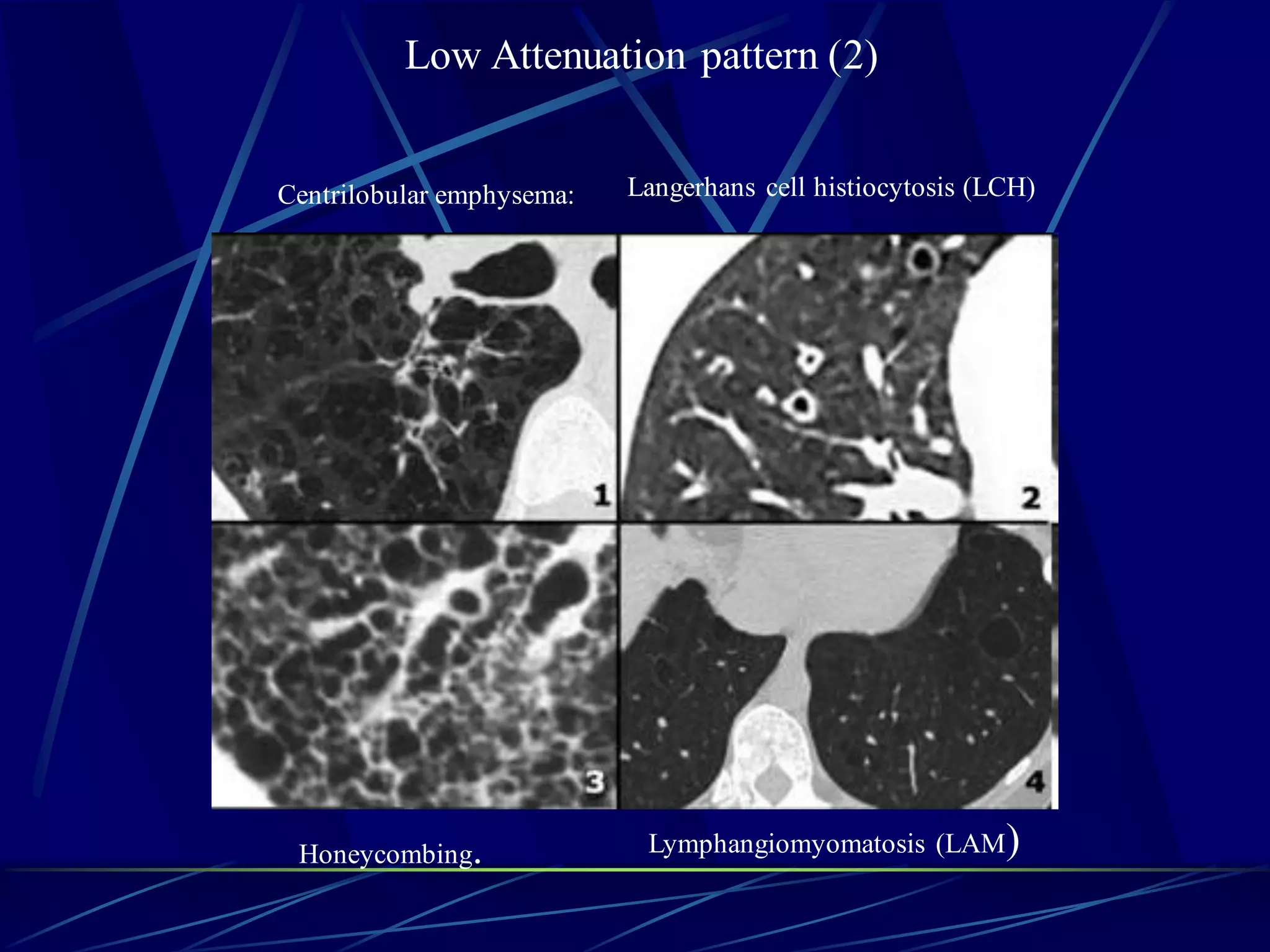Low Attenuation pattern (2)
Centrilobular emphysema: Langerhans cell histiocytosis (LCH)
Honeycombing. Lymphangiomyomatosis (LAM)
 