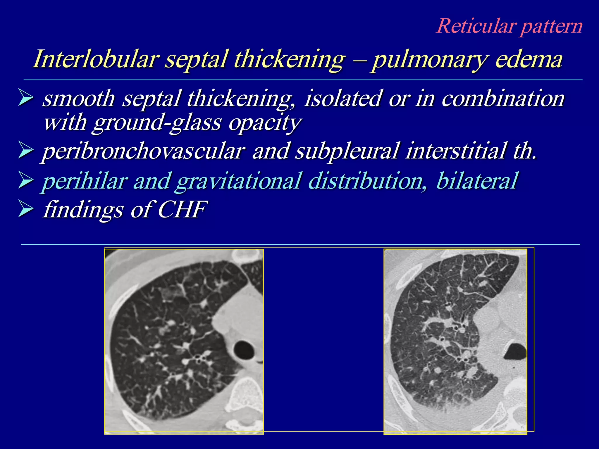 Reticular pattern
Interlobular septal thickening – pulmonary edema
 smooth septal thickening, isolated or in combination
with ground-glass opacity
 peribronchovascular and subpleural interstitial th.
 perihilar and gravitational distribution, bilateral
 findings of CHF
 
