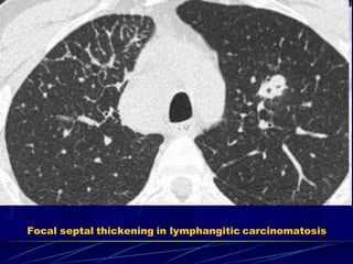 Focal septal thickening in lymphangitic carcinomatosis
 