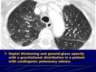 Septal thickening and ground-glass opacity
with a gravitational distribution in a patient
with cardiogenic pulmonary edema.
 