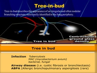 Tree-in-bud
Tree-in-buddescribesthe appearance of an irregularand often nodular
branchingstructure, most easily identifiedin the lung periphery.
 