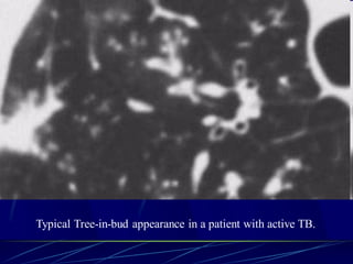 Typical Tree-in-bud appearance in a patient with active TB.
 