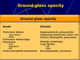 Ground-glass opacity
 