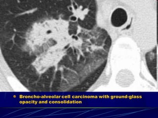Broncho-alveolar cell carcinoma with ground-glass
opacity and consolidation
 