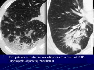 Two patients with chronic consolidations as a result of COP
(cryptogenic organizing pneumonia)
 