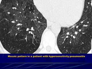 Mosaic pattern in a patient with hypersensitivity pneumonitis
 