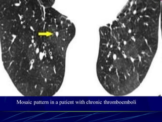 Mosaic pattern in a patient with chronic thromboemboli
 