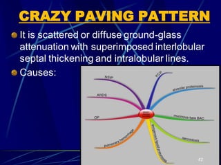 CRAZY PAVING PATTERN
It is scattered or diffuse ground-glass
attenuation with superimposed interlobular
septal thickening and intralobular lines.
Causes:
42
 
