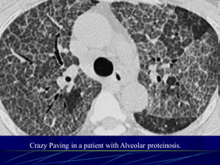 Crazy Paving in a patient with Alveolar proteinosis.
 