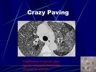 Crazy Paving
Combination of ground glass
opacity and septal thickening :
Alveolar proteinosis.
 