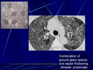 Combination of
ground glass opacity
and septal thickening
: Alveolar proteinosis45
 