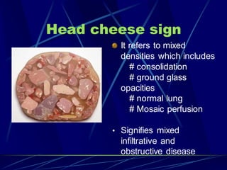 Head cheese sign
It refers to mixed
densities which includes
# consolidation
# ground glass
opacities
# normal lung
# Mosaic perfusion
• Signifies mixed
infiltrative and
obstructive disease
 