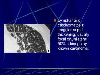 Lymphangitic
carcinomatosis:
irregular septal
thickening, usually
focal or unilateral
50% adenopathy',
known carcinoma.
 