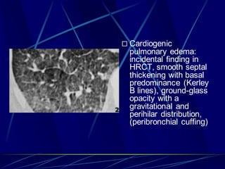  Cardiogenic
pulmonary edema:
incidental finding in
HRCT, smooth septal
thickening with basal
predominance (Kerley
B lines), ground-glass
opacity with a
gravitational and
perihilar distribution,
(peribronchial cuffing)
 