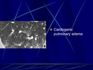 Cardiogenic
pulmonary edema
 