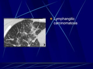 Lymphangitic
carcinomatosis
 