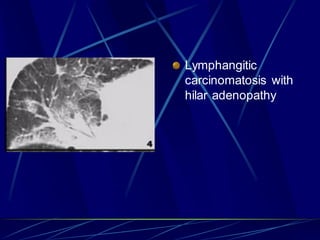 Lymphangitic
carcinomatosis with
hilar adenopathy
 