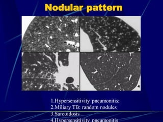 Nodular pattern
1.Hypersensitivity pneumonitis:
2.Miliary TB: random nodules
3.Sarcoidosis
4.Hypersensitivity pneumonitis
 