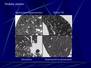 Nodular pattern
Hypersensitivity pneumonitis Miliary TB
Sarcoidosis Hypersensitivity pneumonitis
 